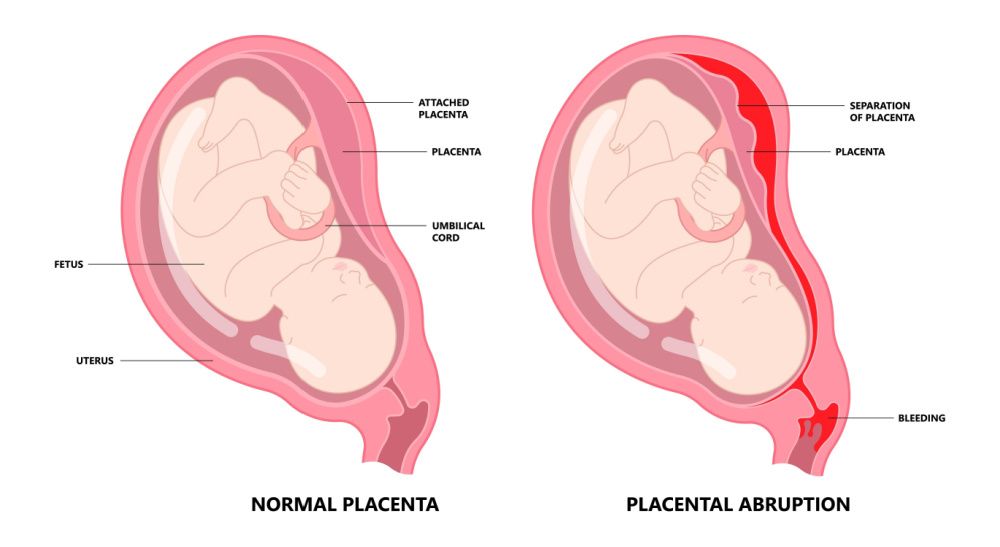 Placenta-Previa-2-1.jpg