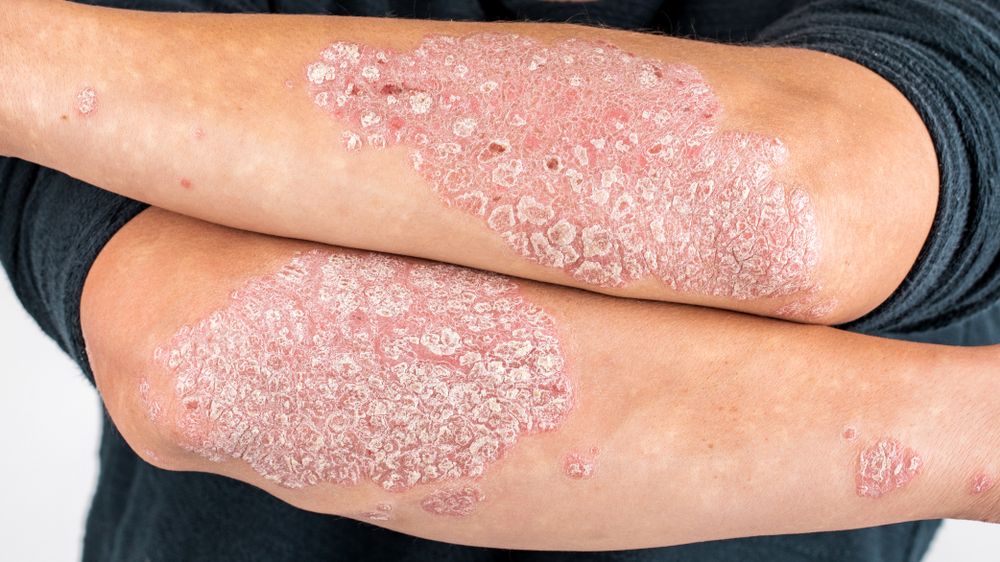 Psoriasis.jpg