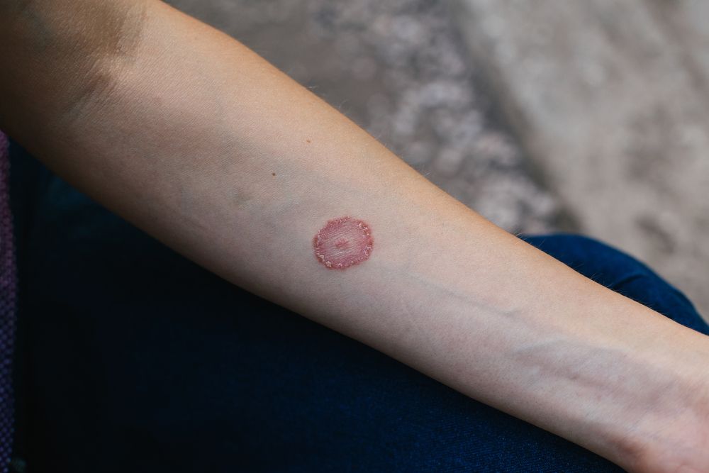 Ringworm.jpg