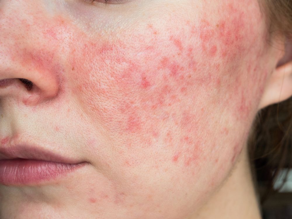 Rosacea.jpg