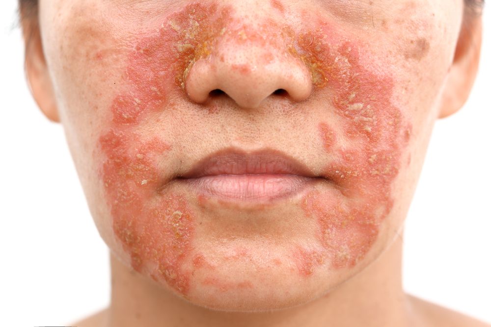 Seborrheic-eczema.jpg