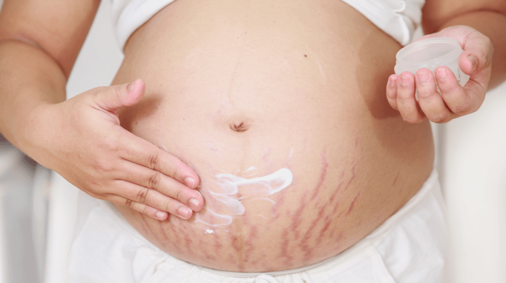 Skin-changes-and-stretch-marks-1024x573.png