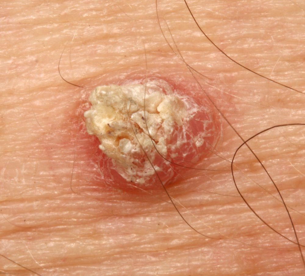 Squamous-cell-carcinoma.jpg