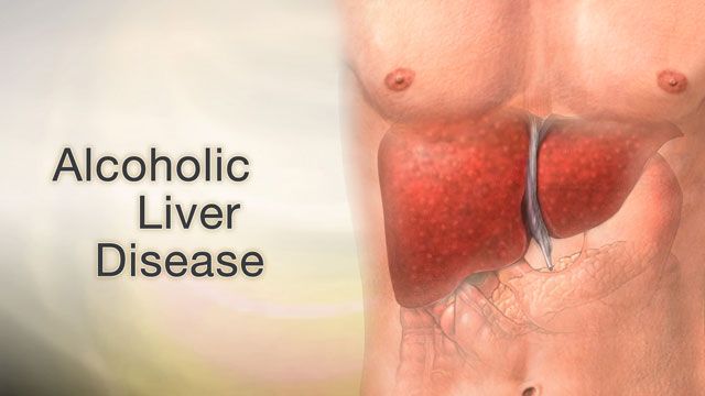 Stages of Alcoholic Liver Disease – Docindia.org