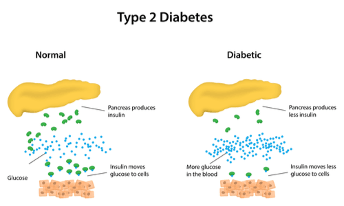Type-2-Diabetes.png