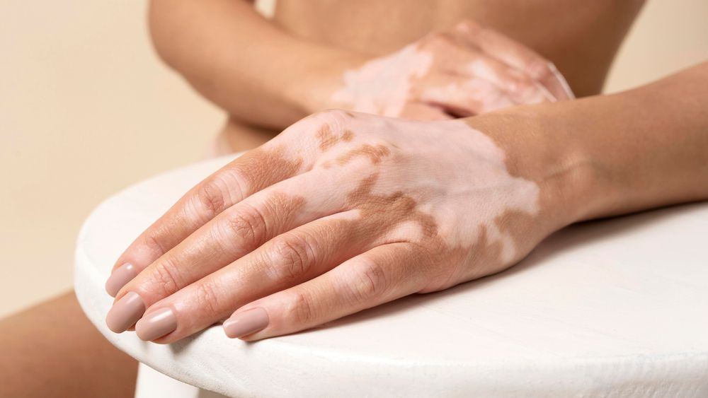 Vitiligo.jpg
