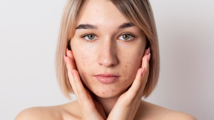 What Happens to Your Skin if You Have PCOS?