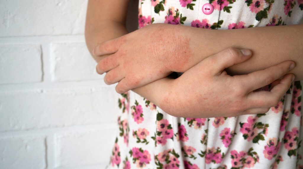 contact-dermatitis-1024x573.jpg