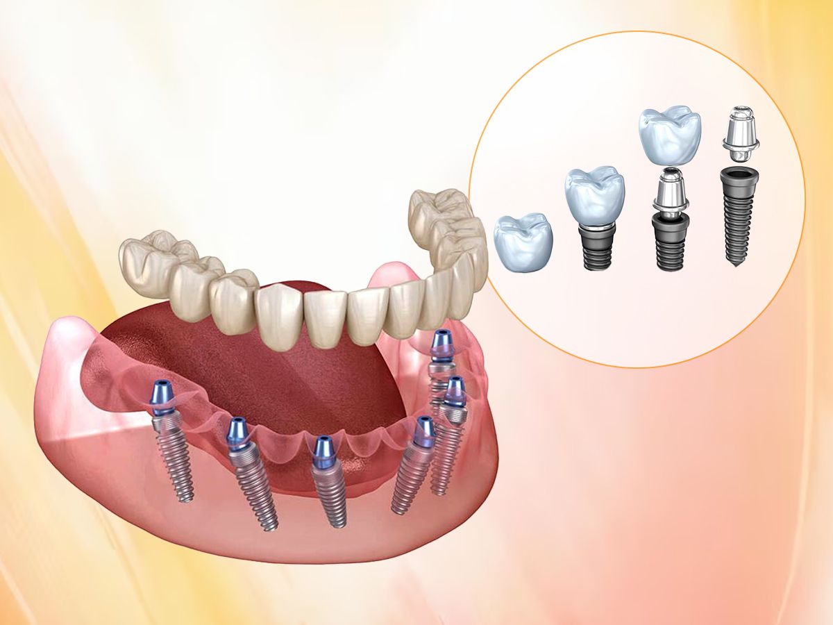 dental-implants.jpg
