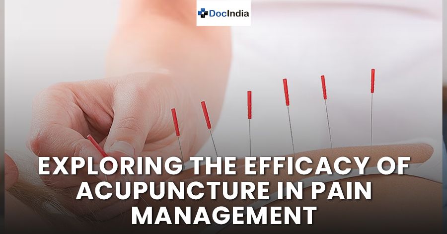 Exploring the Efficacy of Acupuncture in