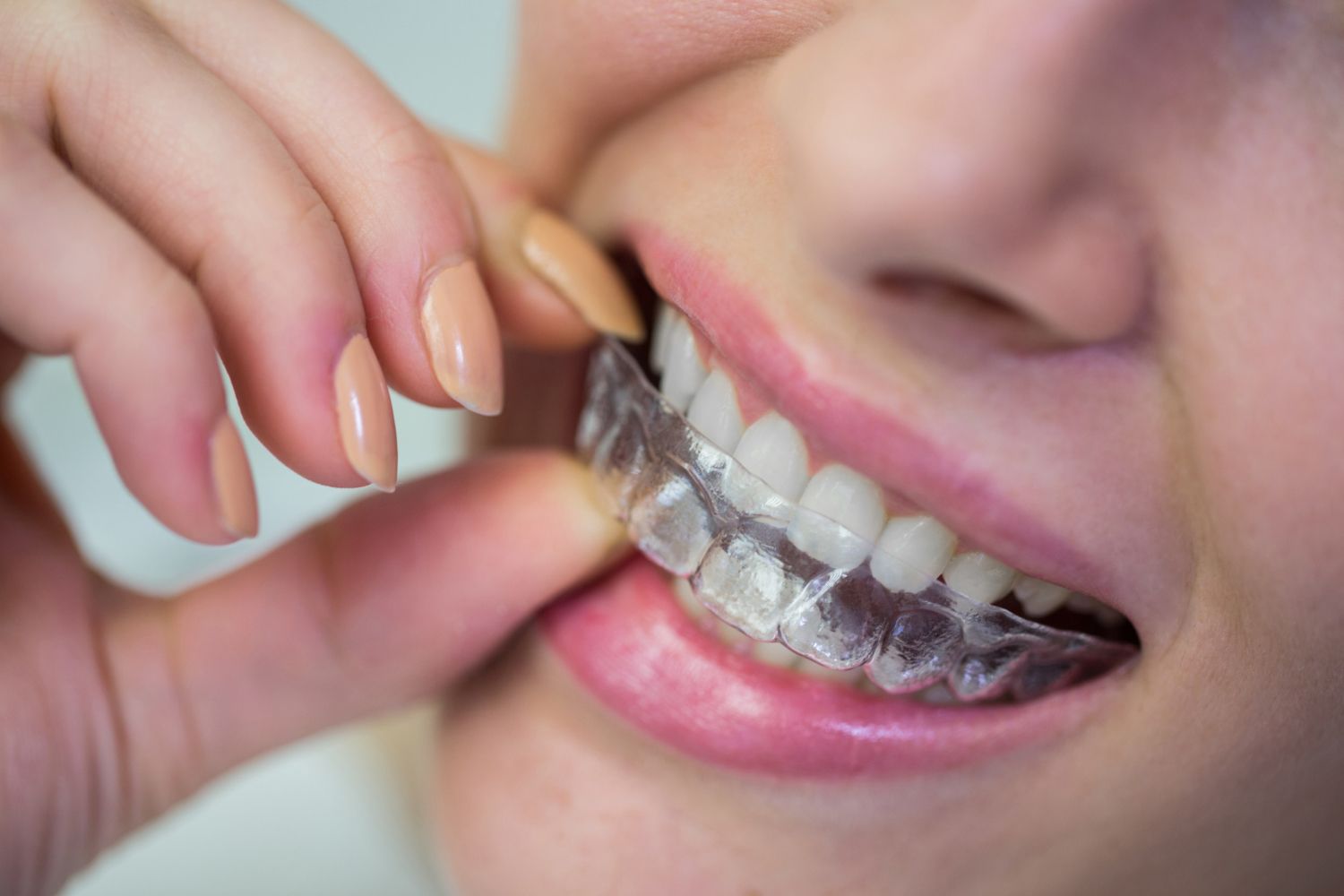 Partial Dentures: A Comfortable Implant Alternative