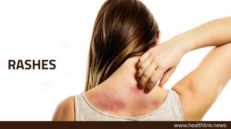 Skin Rashes: Types, Causes, and Treatment