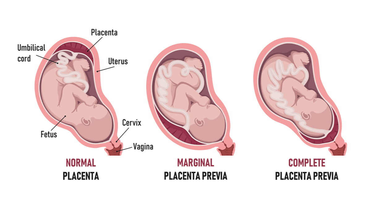 types-of-placenta-previa.png