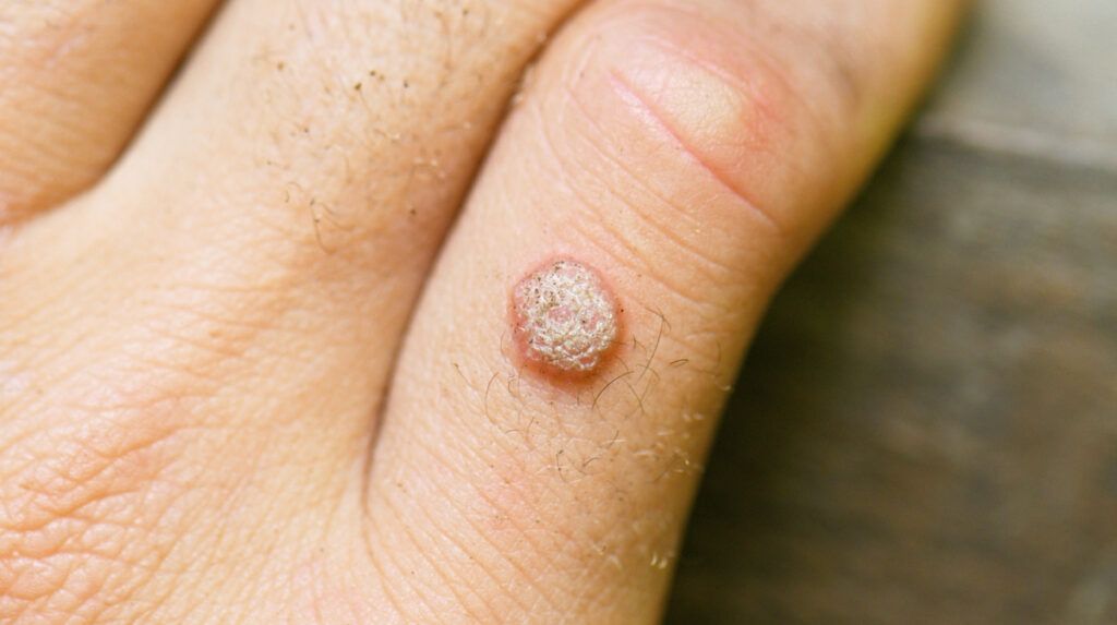 wart-1024x573.jpg